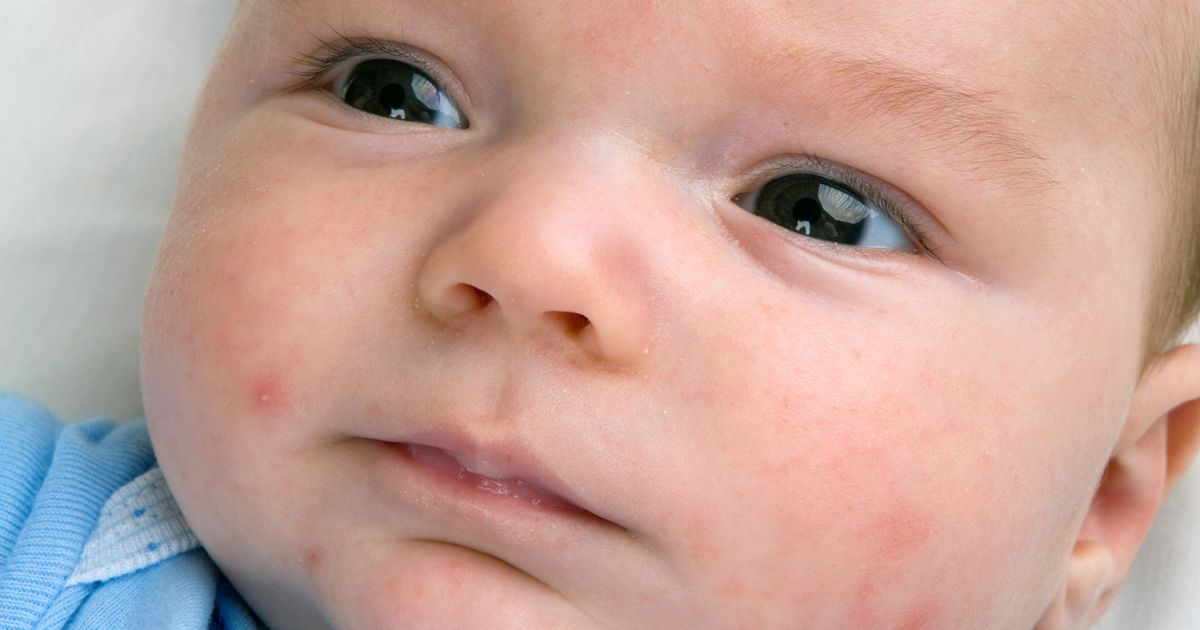 Baby Pimples And Skin Conditions How To Spot Them And How To Treat